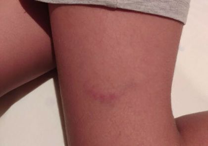 Marca de uno de los menores